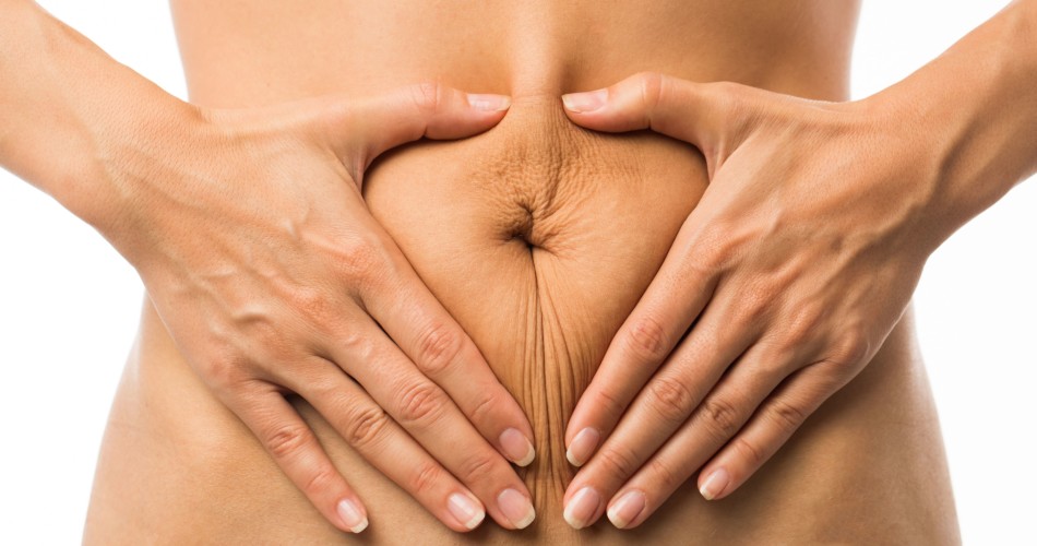Eine Frau hält ihren Bauch - Titelbild zu Beitrag über das Schließen einer Rektusdiastase.