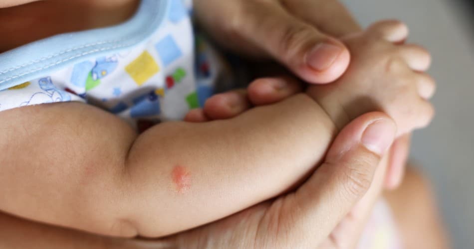 Ein Mückenstich auf dem Arm eines Babys.