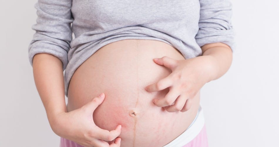 Eine Frau hat einen Hautausschlag in der Schwangerschaft und kratzt ihren Bauch.