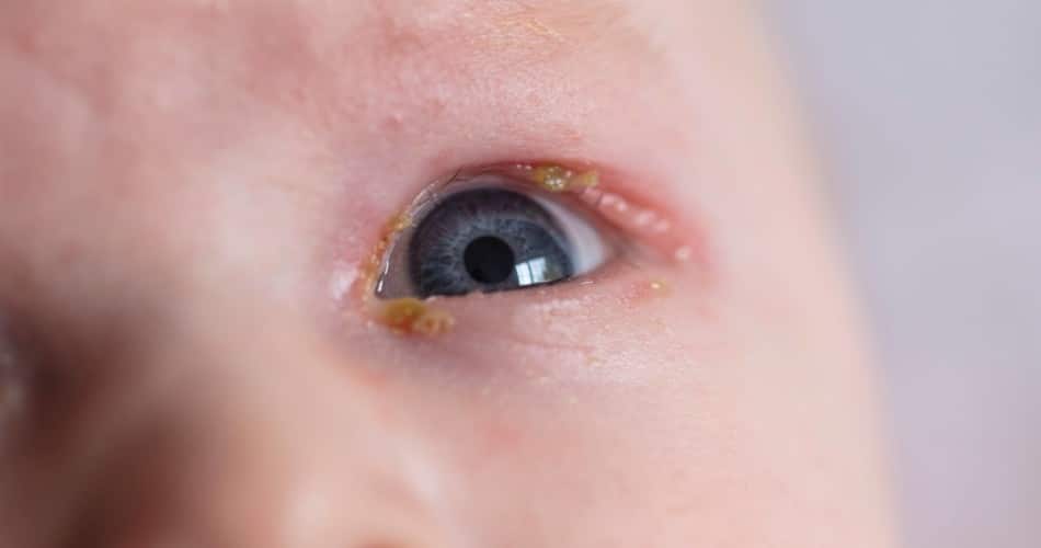 Gelber Schleim im Auge eines Babys.