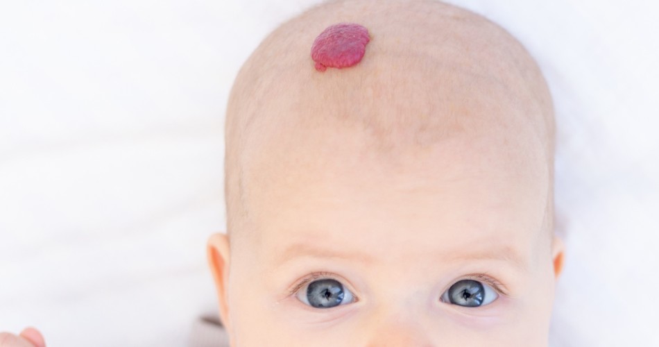 Ein Baby mit einem Blutschwämmchen.